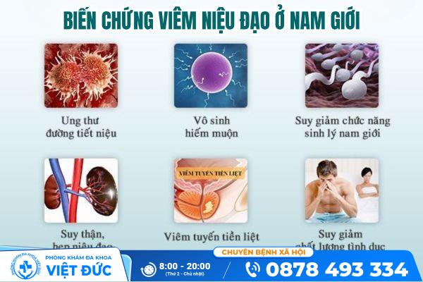 Viêm niệu đạo ở nam giới và những thông tin cần biết 13 Biến chứng viêm niệu đạo ở nam giới