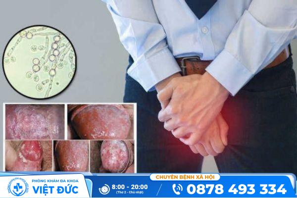 Triệu chứng nấm vùng kín và cách hỗ trợ điều trị hiệu quả 18 Những hình ảnh nấm vùng kín ở nam giới