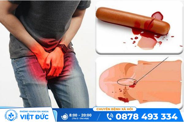 Sự thật triệu chứng chảy máu dương vật có gây nguy hiểm không? 35 Hiện tượng chảy máu dương vật do bệnh lý
