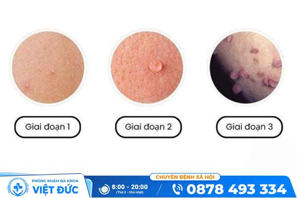 Dấu hiệu nhận biết mụn cóc sinh dục và cách chữa hiệu quả 2 Mụn cóc sinh dục là gì?